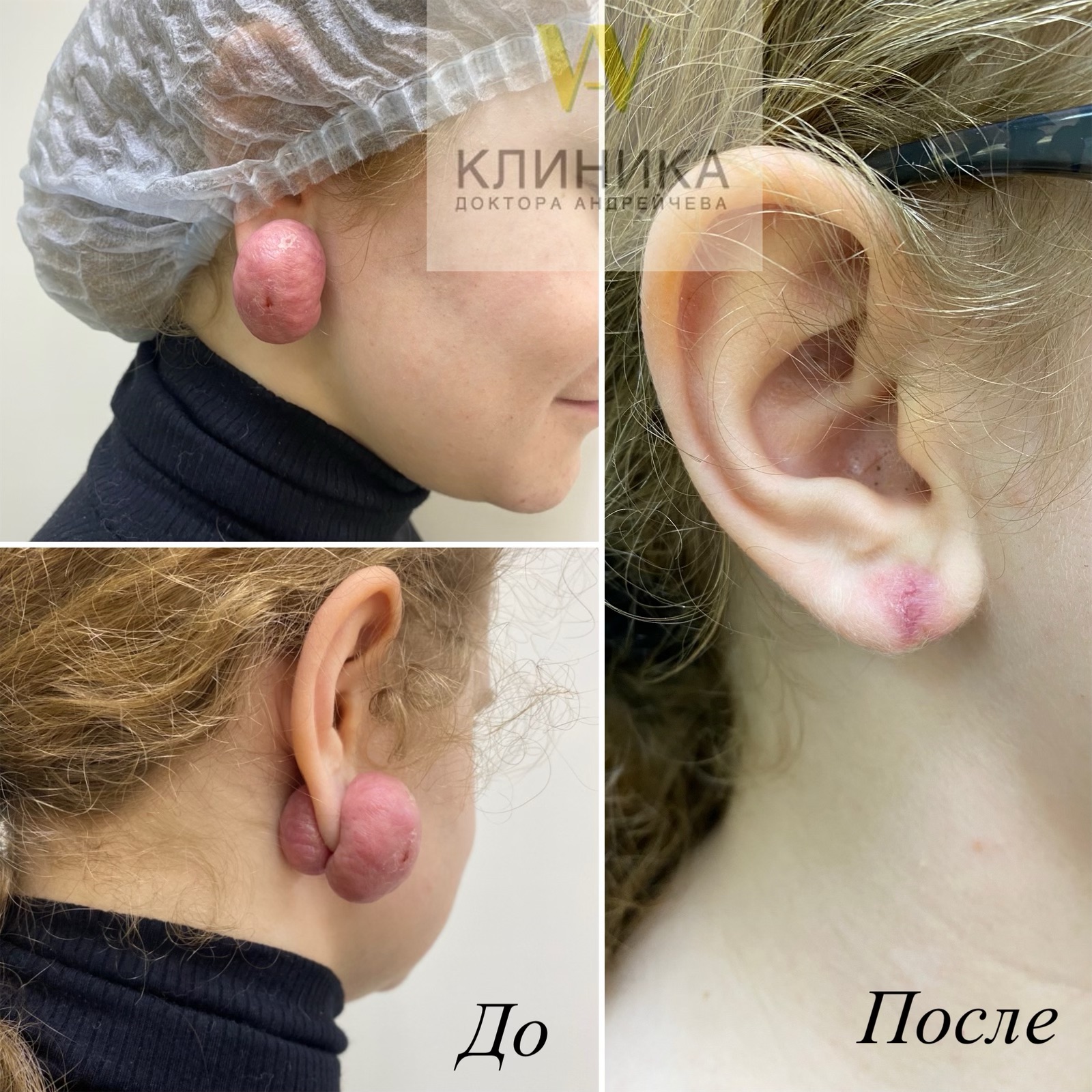 Лечение рубцовой деформации мочки уха радиоволновым методом